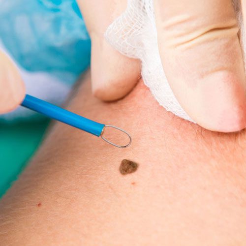 Mole Removal